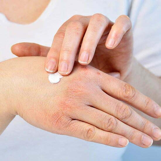 Hauttrockenheit kann auf einen Omega-3-Mangel hinweisen Trockene Hand wird eingecremt